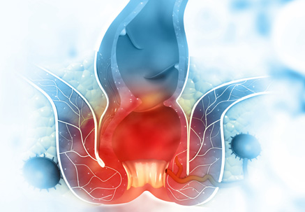 Image of Anal Abscess, Fistula