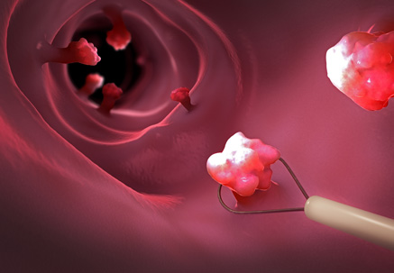 Image of Colonoscopy