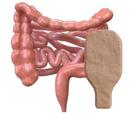 Colostomy Image
