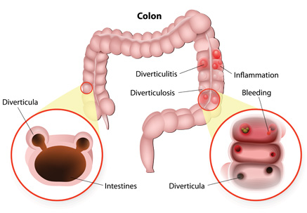 Image of Diverticulosis and Diverticulitis